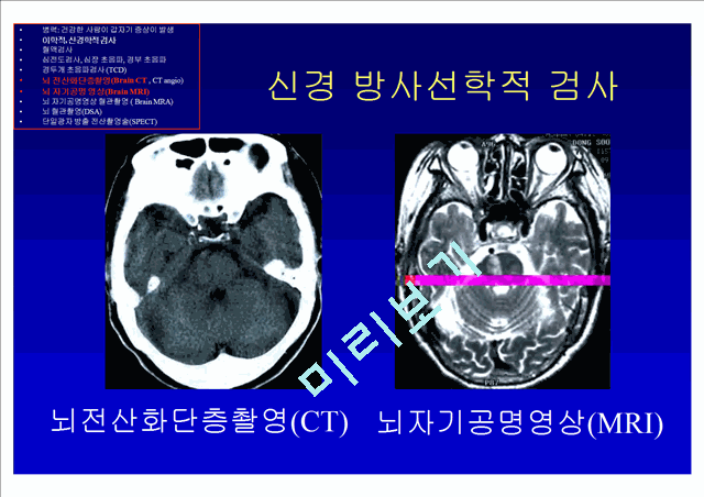 [의학] 뇌졸중의 진단   (8 )